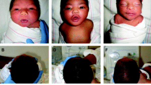 Symptoms of Pediatric Physical Therapy for Plagiocephaly