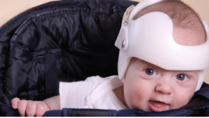 Will my baby need a helmet?