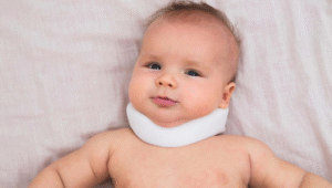 What is torticollis and how is it linked