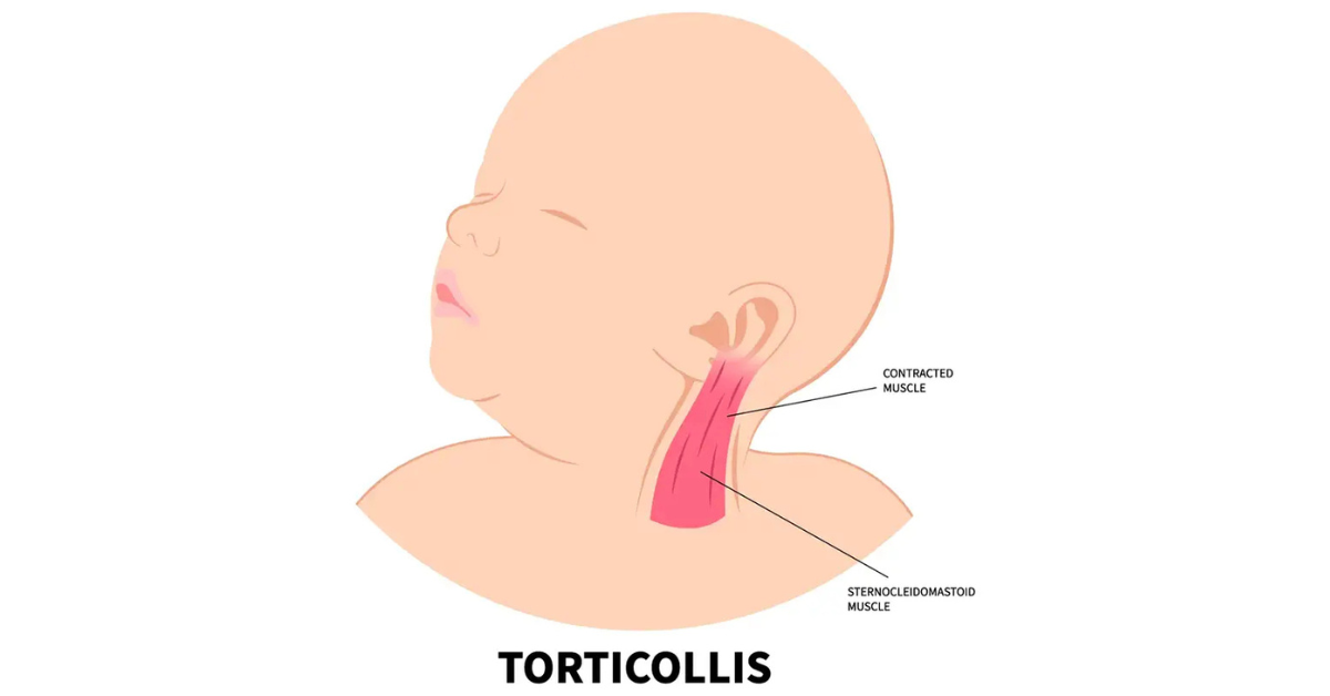 Frequently Asked Questions About Torticollis